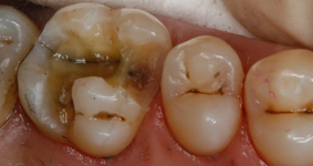 With Facelight, W&H supports rapid and reliable diagnosis of bacterially infected tooth hard substance. 