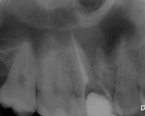 Abb. 3 u. 4: Zustand nach Revision des Wurzelkanals und Darstellung des frakturierten Instruments.