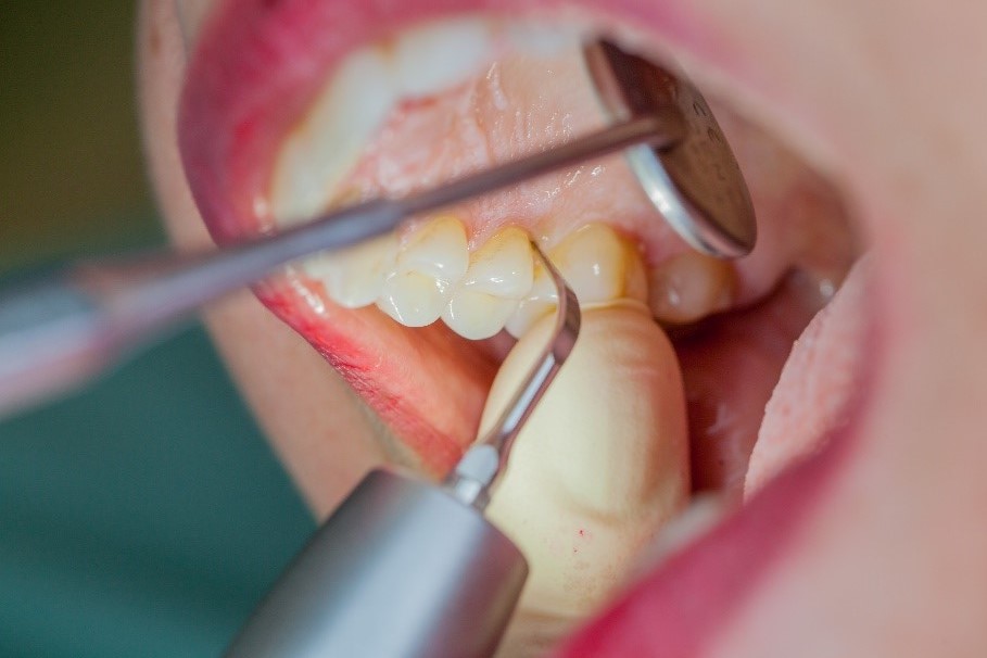 Les dispositifs à ultrasons conviennent particulièrement aux traitements UPT