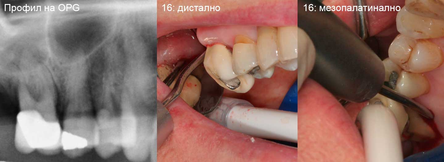 Затворено отстраняване на фуркация на зъб 16 