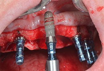 Impianto a livello tissutale da 10 mm
