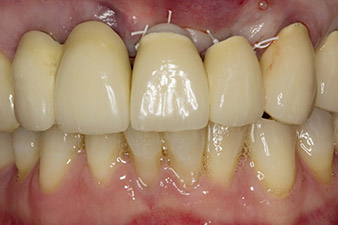 Situación después del implante y del aumento