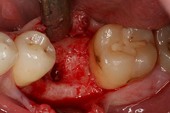 l’ossification de l’alvéole est incomplète 