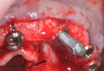 Estabilidad del implante