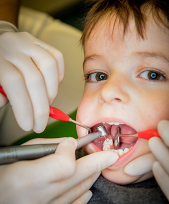 Ideal treatment of primary dentition with the small turbine head