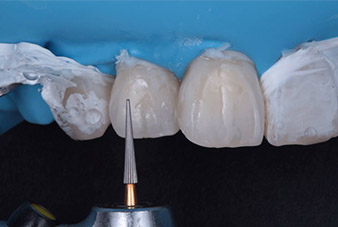 Finitura dei restauri e rimozione del cemento in eccesso