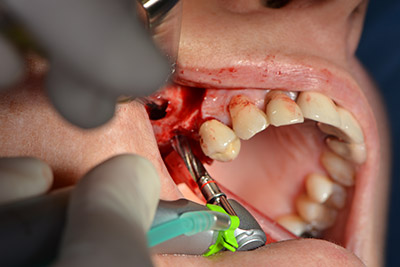 Augmentation with autologous bone 