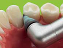 //a.storyblok.com/f/45617/b75f18c23a/polishing-amalgam-interdental.png