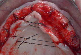 Implant positions