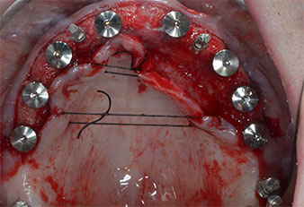 Provisional implants
