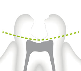 //a.storyblok.com/f/45617/c313ac97e3/illustration-caries-detection.jpg