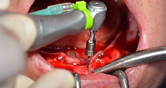 pilot drilling with W&H contra-angle