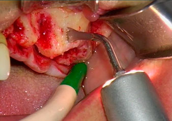 external sinus lift