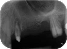 apical periodontal lesion at tooth 24