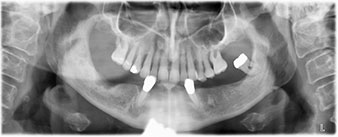 residual dentition