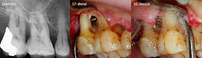 Offenes Debridement der Furkationen an 16 und 17