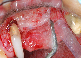 instrumento de raspado piezoeléctrico