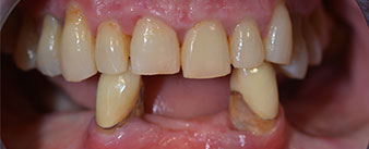 dentición residual 