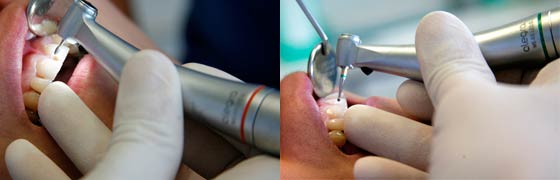 Alegra contra-angle handpieces with LED+ and generator 