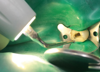 to trace all root canals 