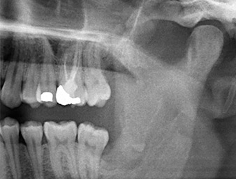 Radiografia panoramica 6 mesi dopo l'osteotomia