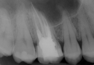 Abb. 7: Kontrollröntgenbild nach Abschluss der Wurzelfüllung. 