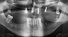 Implantes