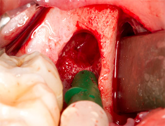 inferior alveolar nerve 