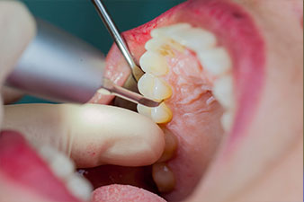 Détartreur piézo Tigon+