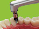 //a.storyblok.com/f/45617/f1334f3054/polishing-interdental.png
