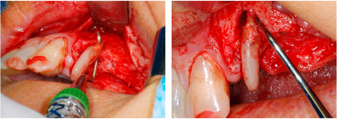 la raíz bucal de la pieza 24 mostraba una pérdida total del hueso y de la fijación
