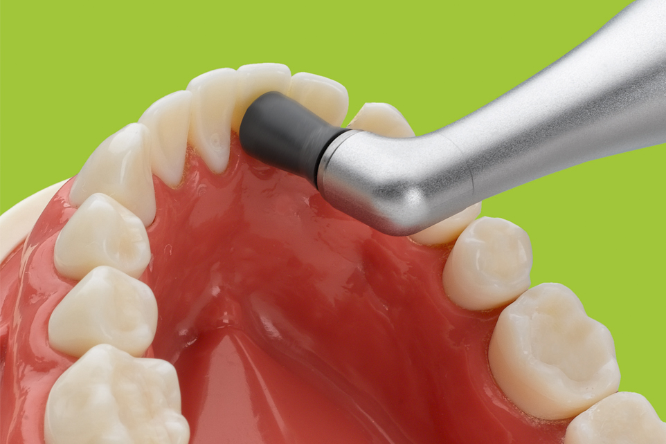 Polishing <br>Prophylaxis