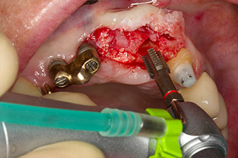 Tapping with the WS-75 L contra-angle handpiece