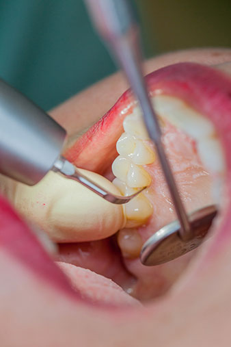 Punta universale 1P per la pulizia atraumatica delle superfici dentali nell'ambito della terapia periodontale di supporto.