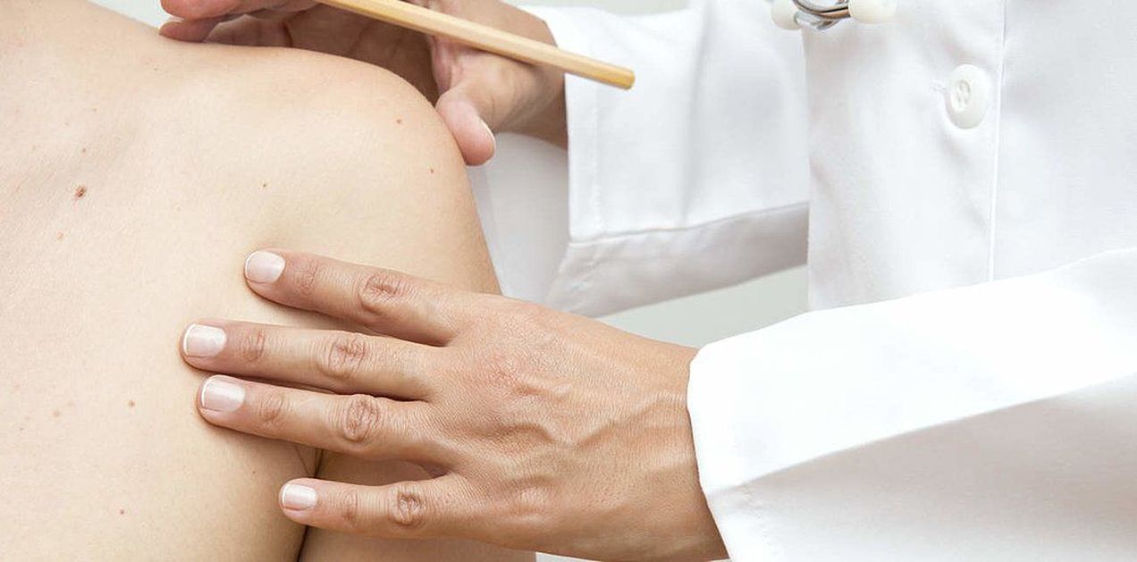 Родинка или меланома? Простые критерии, которые должен знать каждый