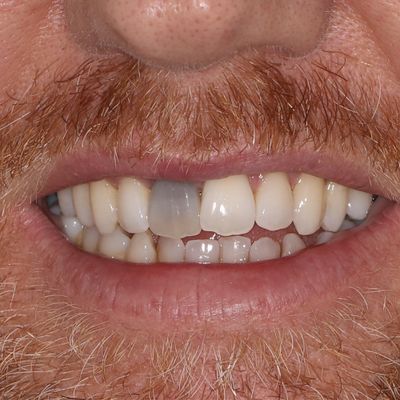 Prosthodontic Treatments | Dental Prostheses // 3Dental In Dublin ...