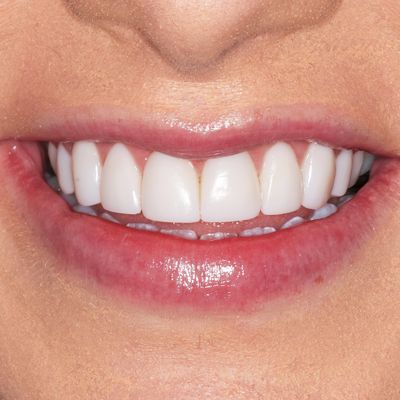 Prosthodontic Treatments | Dental Prostheses // 3Dental In Dublin ...