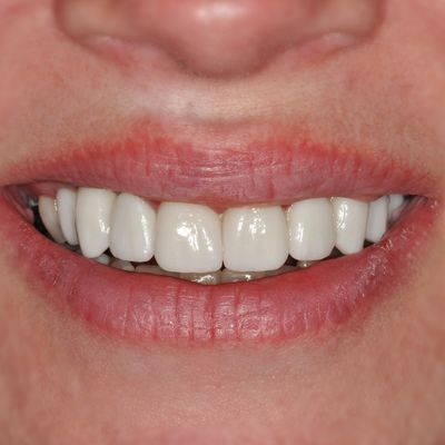 Prosthodontic Treatments | Dental Prostheses // 3Dental In Dublin ...