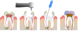 Root canal treatment procedure graph