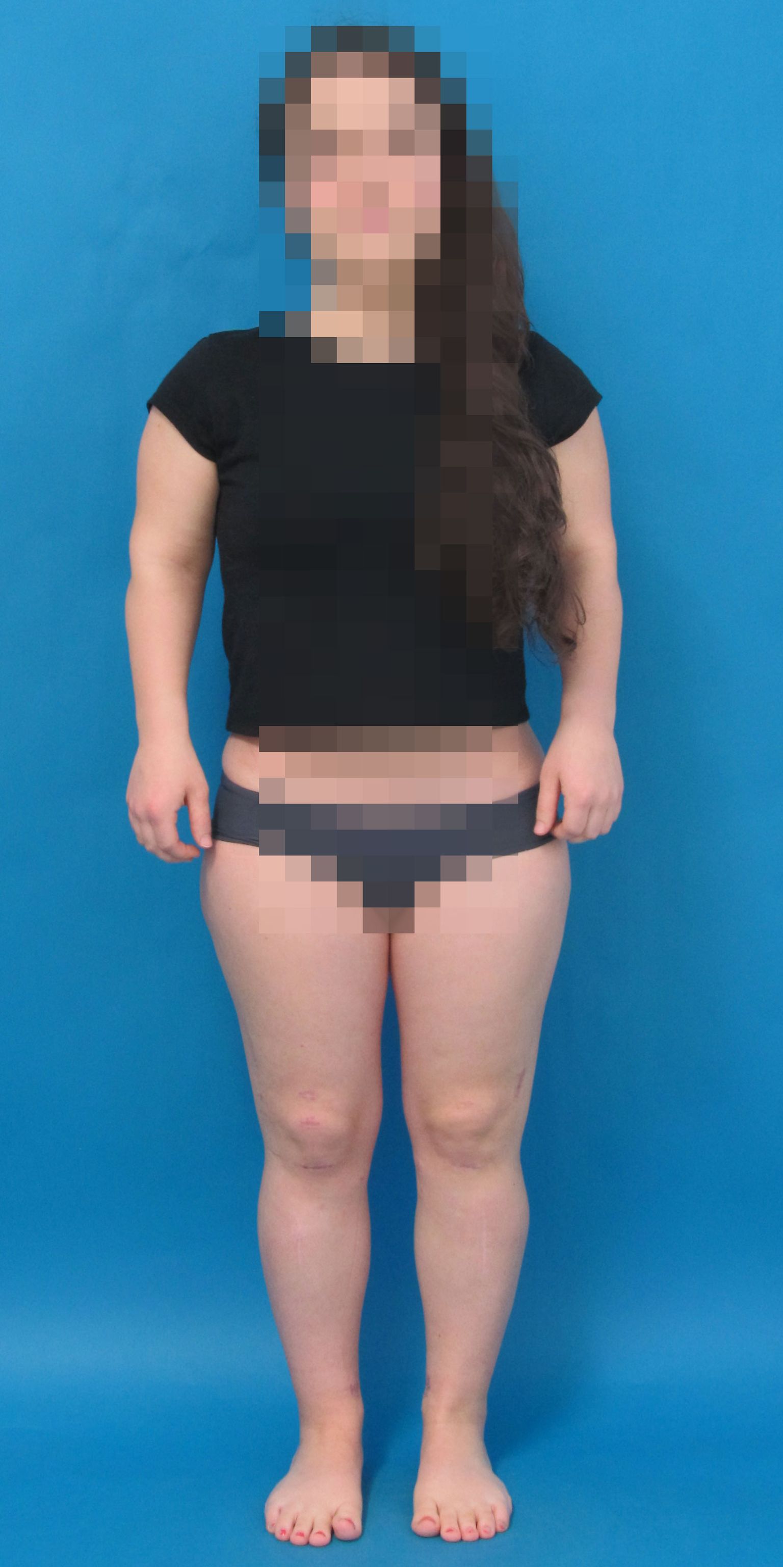After completion of the treatment