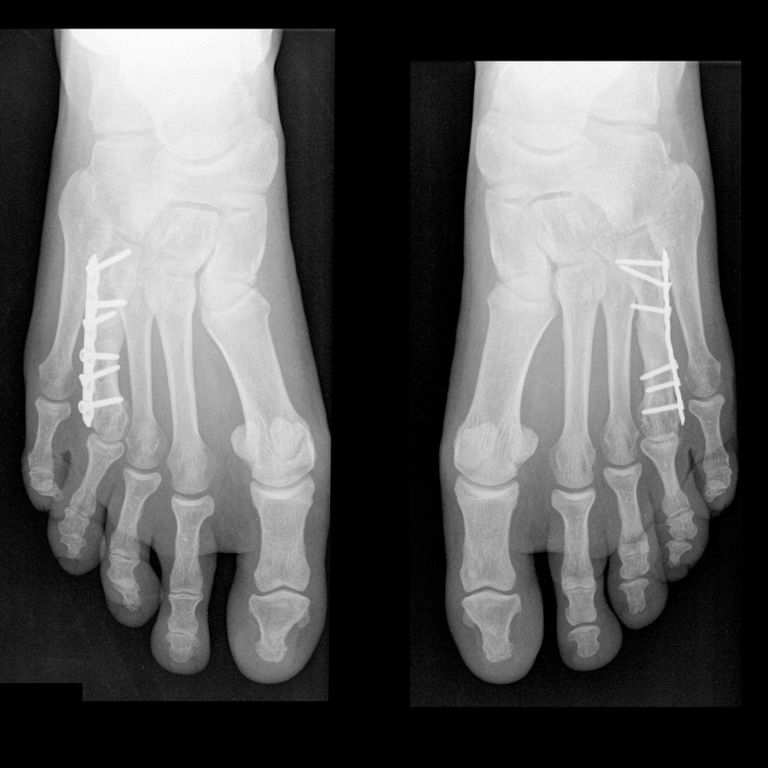 Two small plates protect the newly formed metatarsal bones.