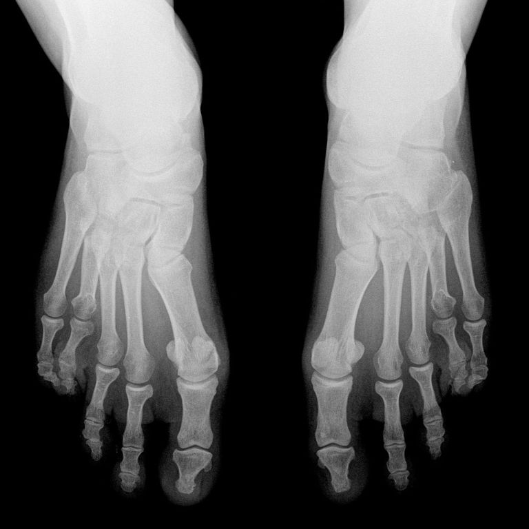 The metatarsal heads of both feet are not in a row