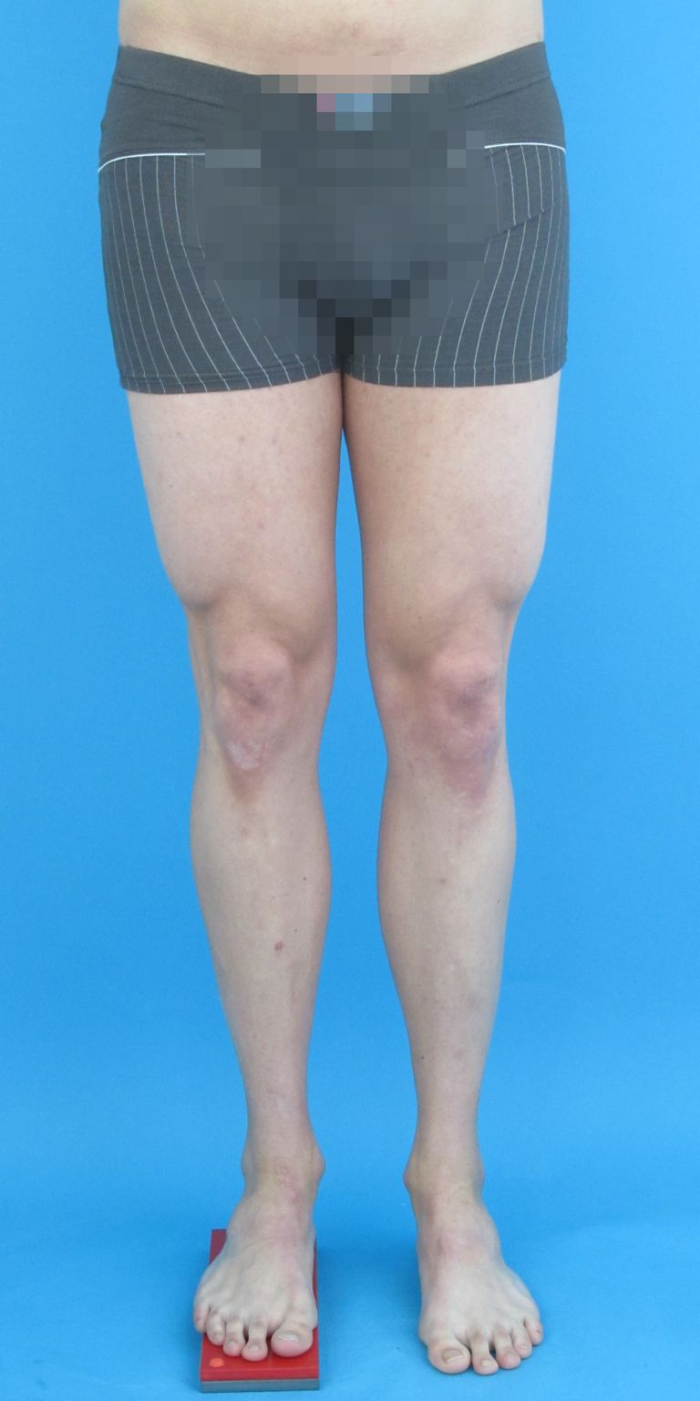 The right thigh is significantly shorter