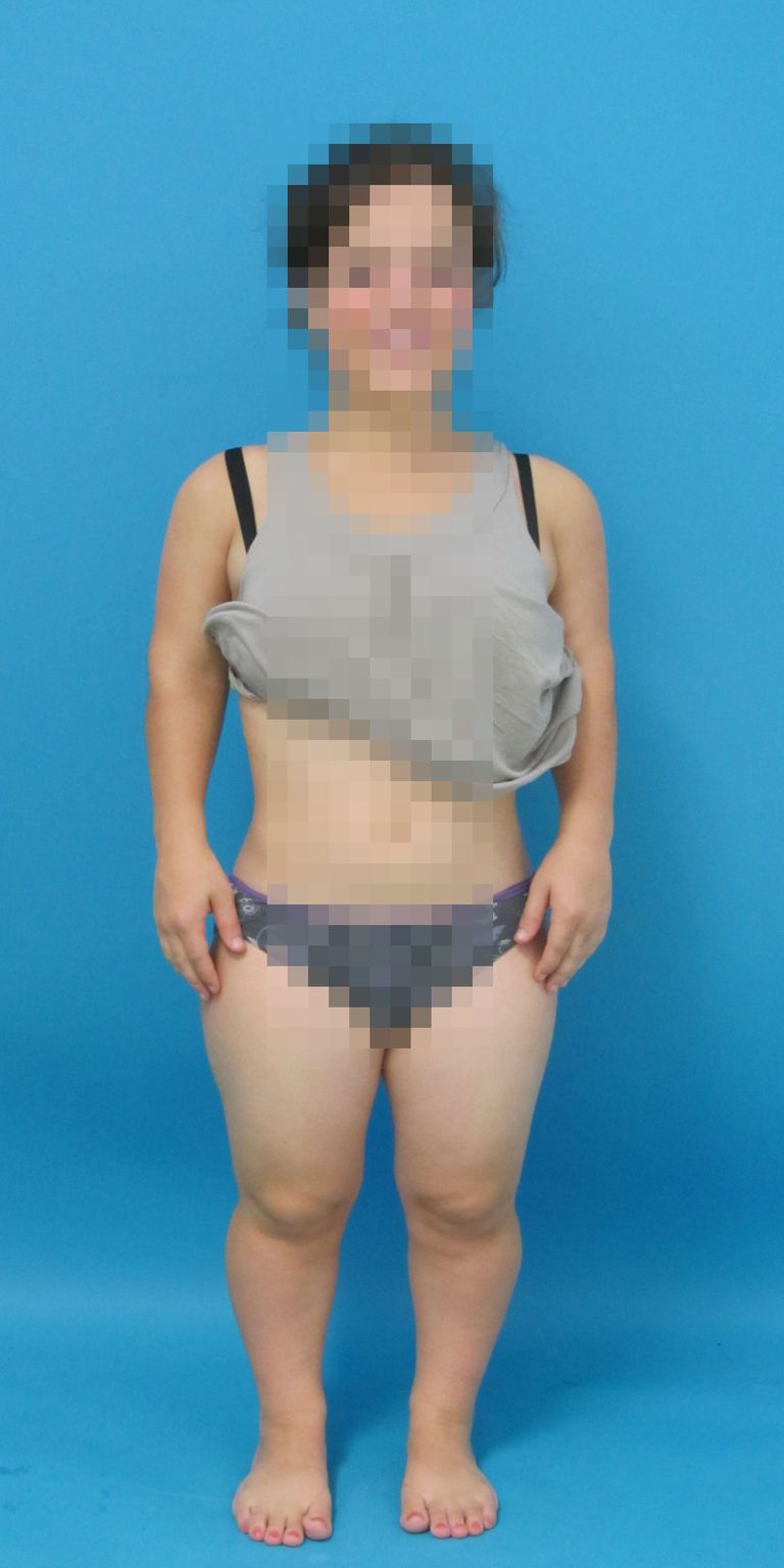 Disproportionierter Kleinwuchs bei Achondroplasie