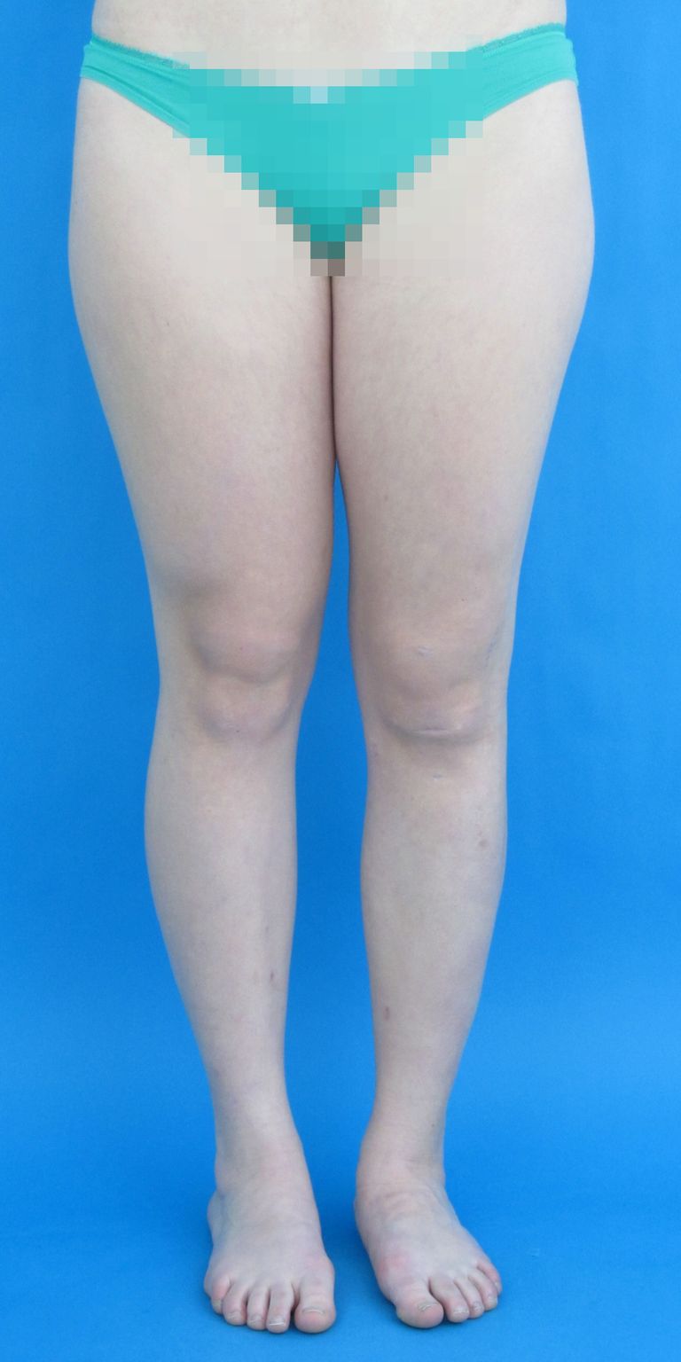 Almost no scars after upper and lower leg lengthening on the left side