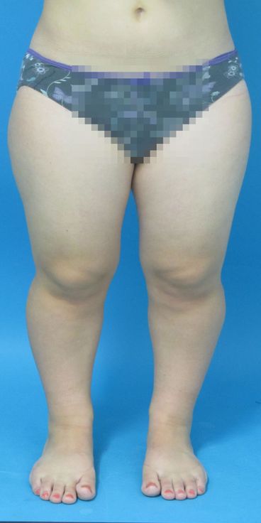Achondroplasie