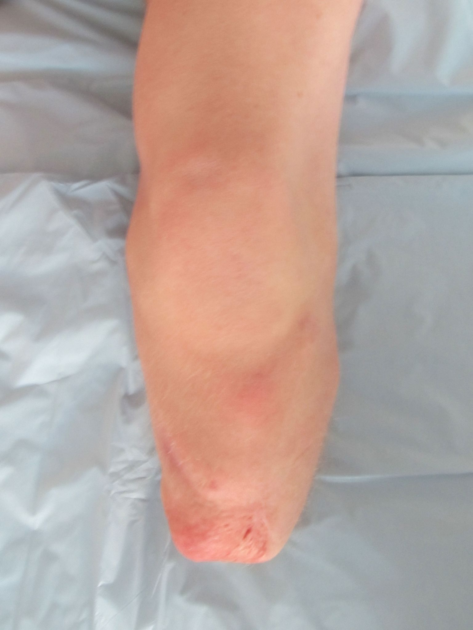 Muñón tibial