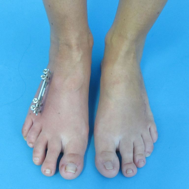 On the right foot the fixator is still mounted, on the left it has already been replaced by a plate.