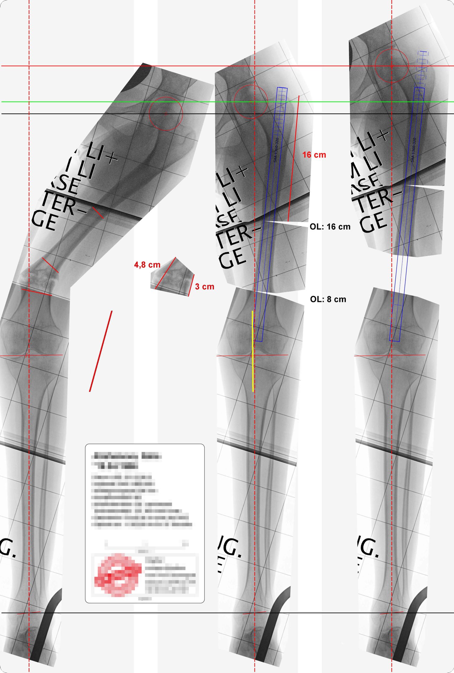 OP-Planung (RPM)