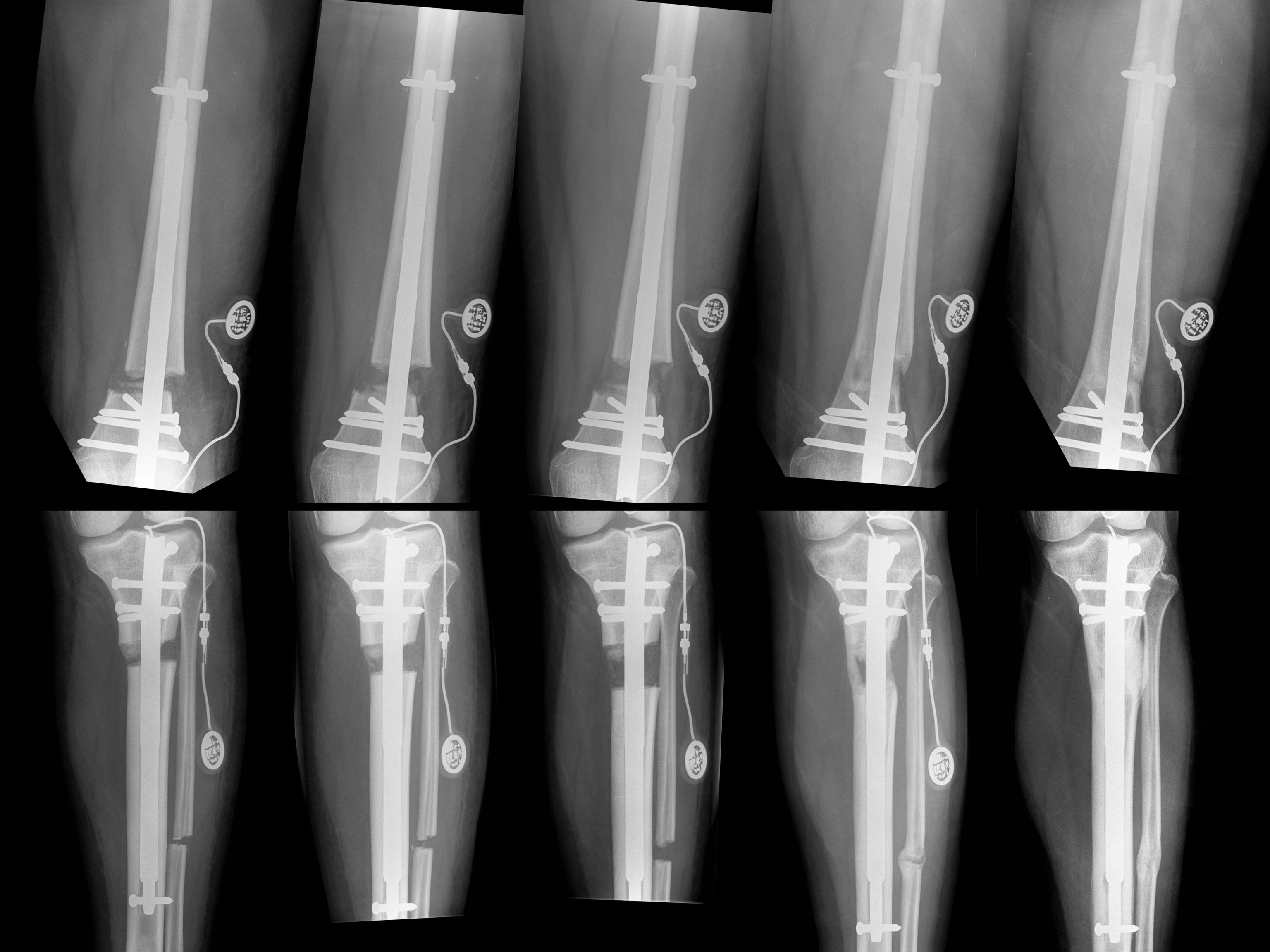 Course of simultaneous upper and lower leg lengthening